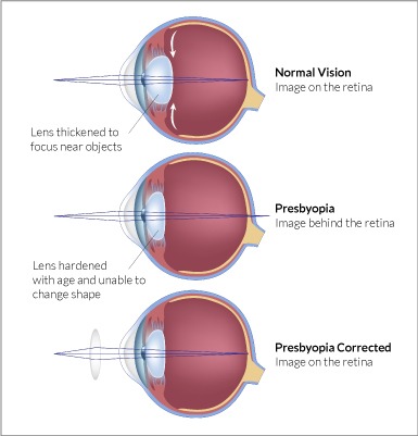 Presbyopia - Swisscoat Europe